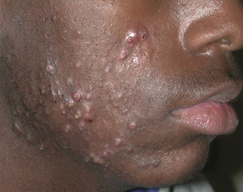 Different types of acne bumps