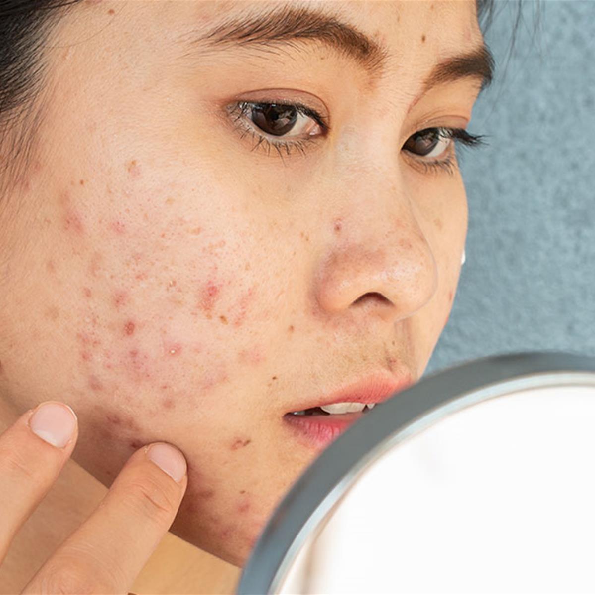 Acne treatment for teenagers
