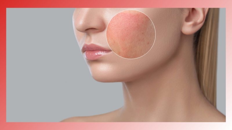 Skin irritation from skincare products